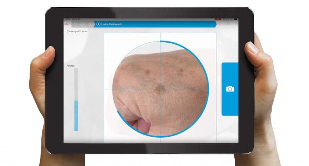 New screening test could revolutionise melanoma skin cancer screening