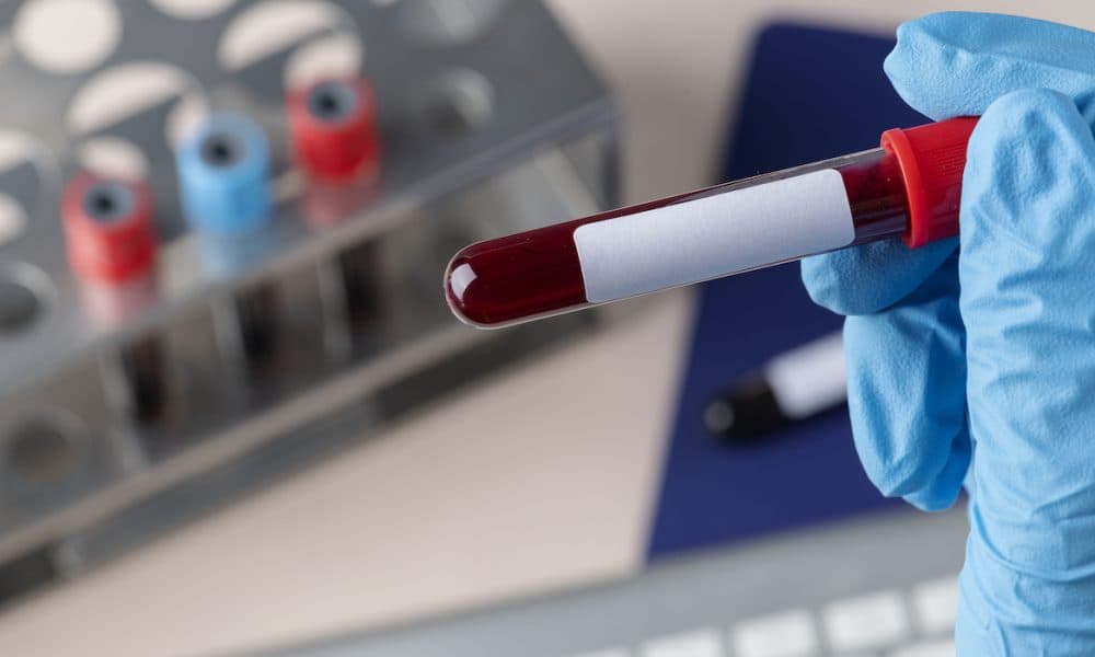 Blood test predicts severe complications in COVID-19 patients