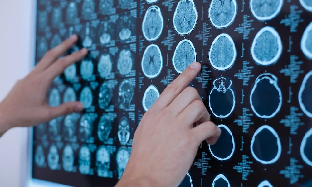 Brain cancer treatment pioneer sets sights on €5m funding