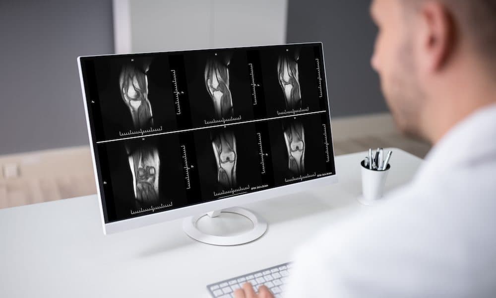 AI-led knee osteoarthritis algorithm given FDA clearance