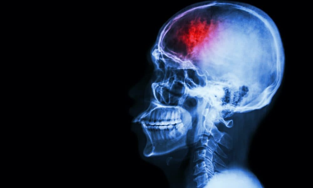 Stroke rehab tech gets £29m funding boost for trials