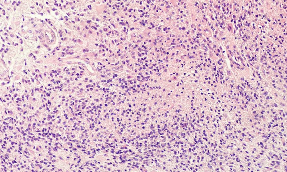 Could this be the long-awaited breakthrough for GBM?