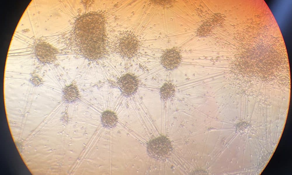 Potential treatment for inherited dementia