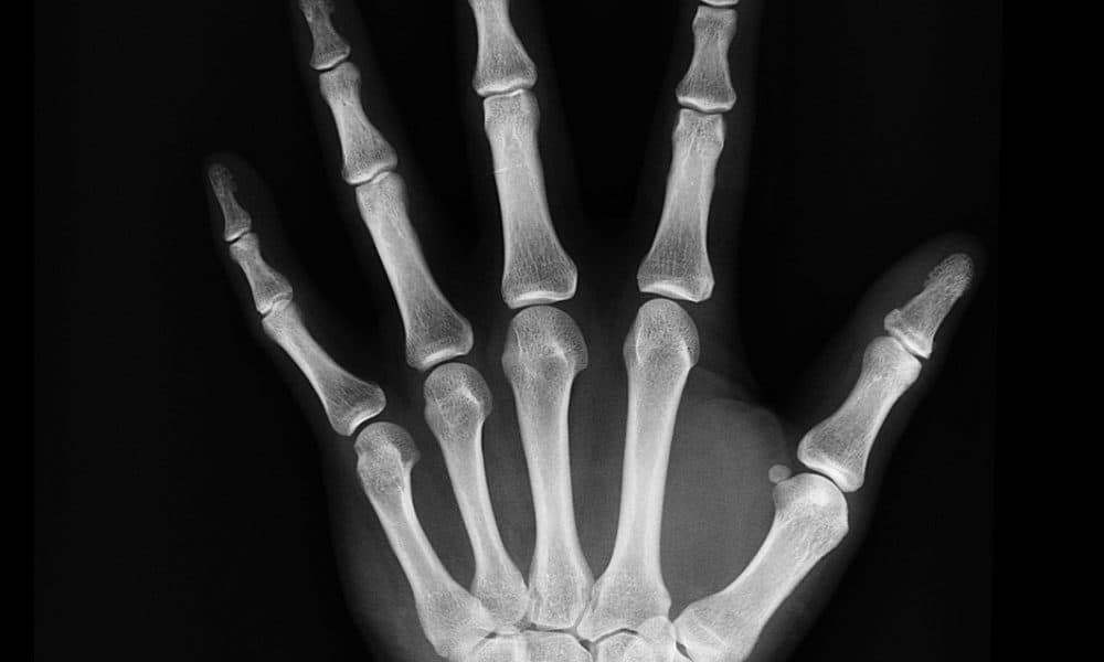 Radiobotics develops algorithms to improve bone fracture X-ray studies