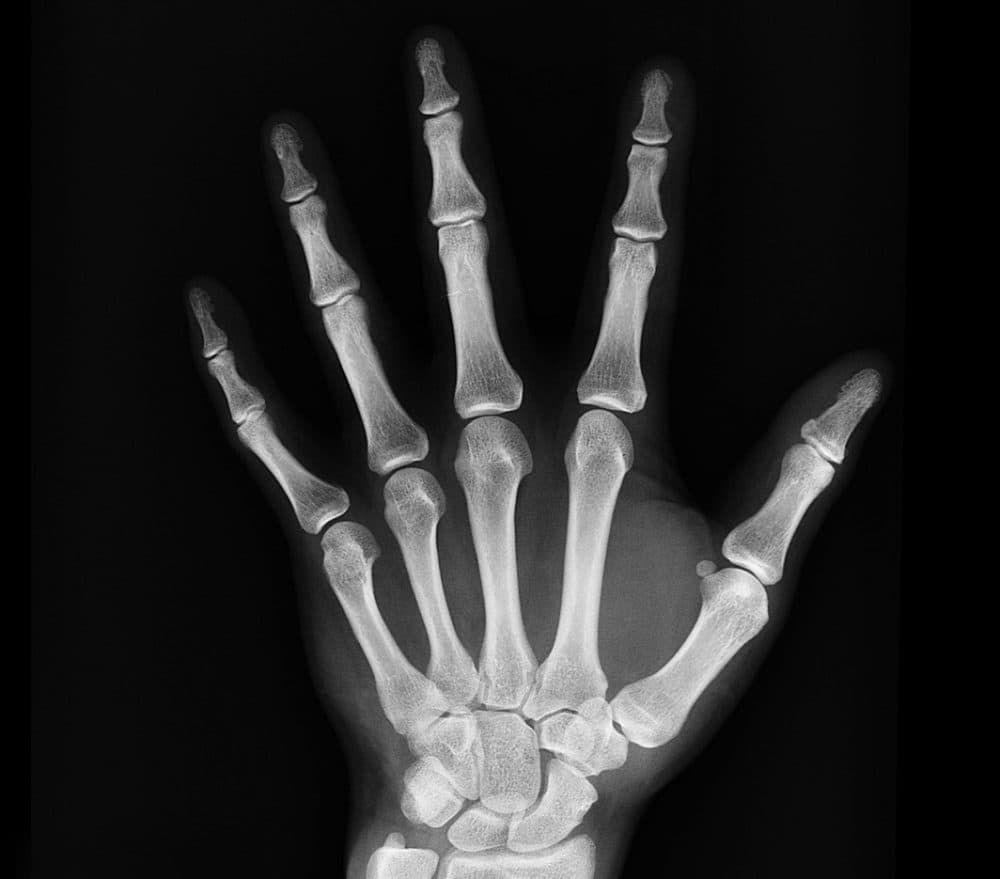 Radiobotics develops algorithms to improve bone fracture Xray studies