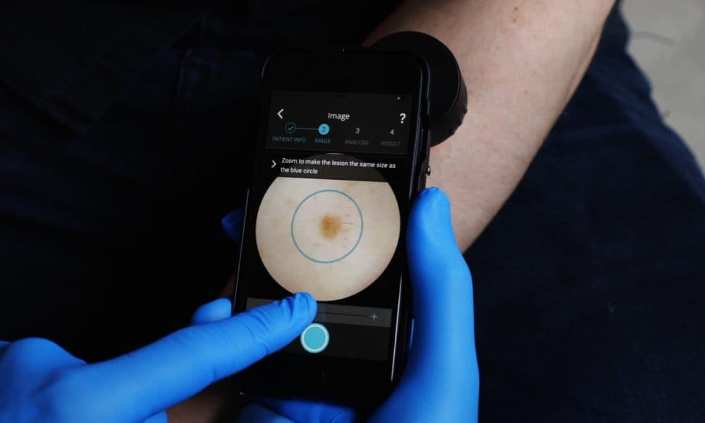 AI Medical Technology trials Dermalyser for diagnosing malignant melanoma