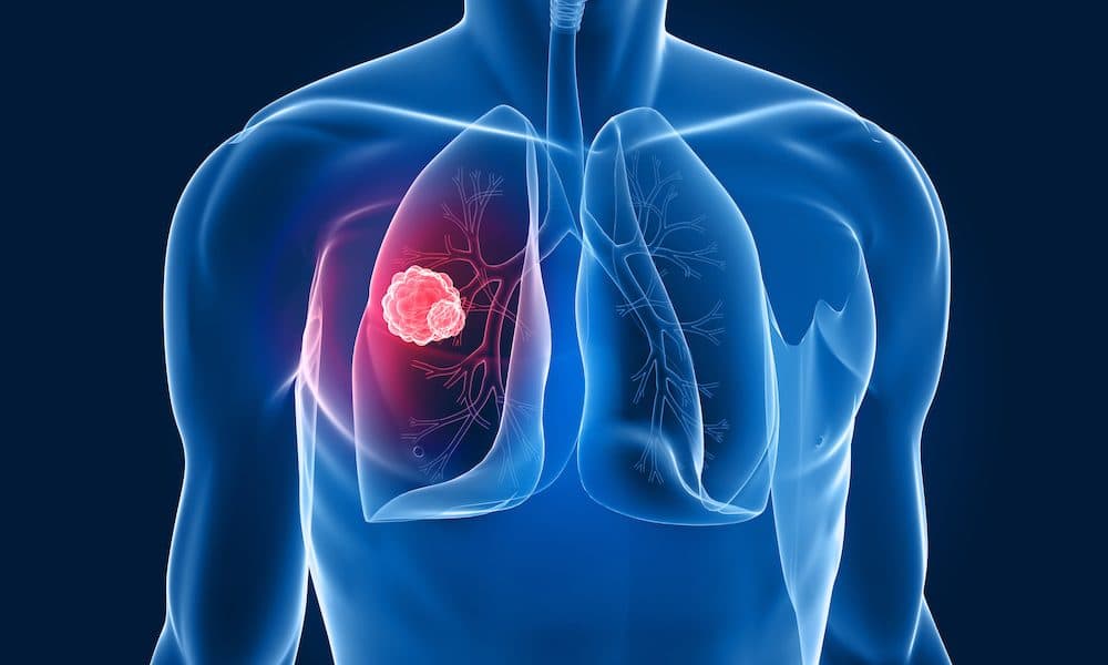 Researchers create AI algorithm for identifying lung cancers