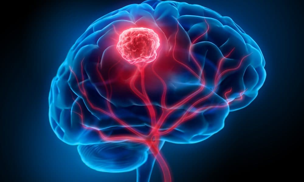 Amethyst UK, first to use new frame to transform patient experience at its London treatment centre Queen Square Radiotherapy Centre