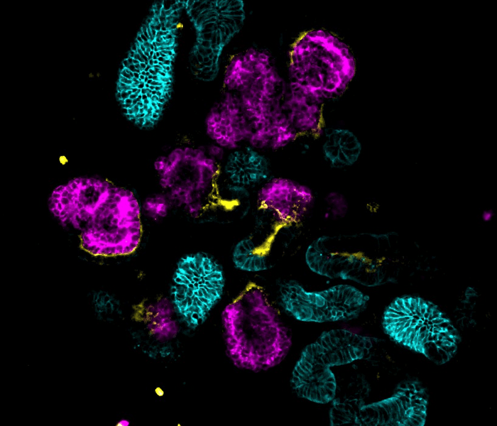 Lab-grown “mini-kidneys” unlock secrets of a rare disease