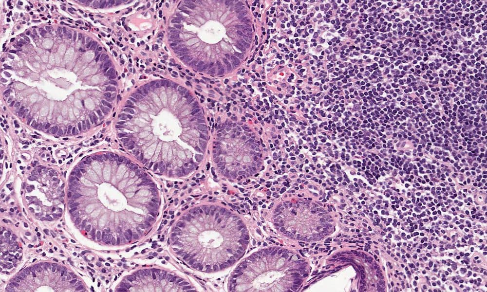 Cancer-spotting AI given EU approval 