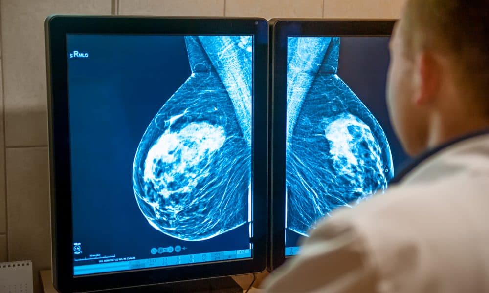 AI catches breast cancer more often than doctors alone