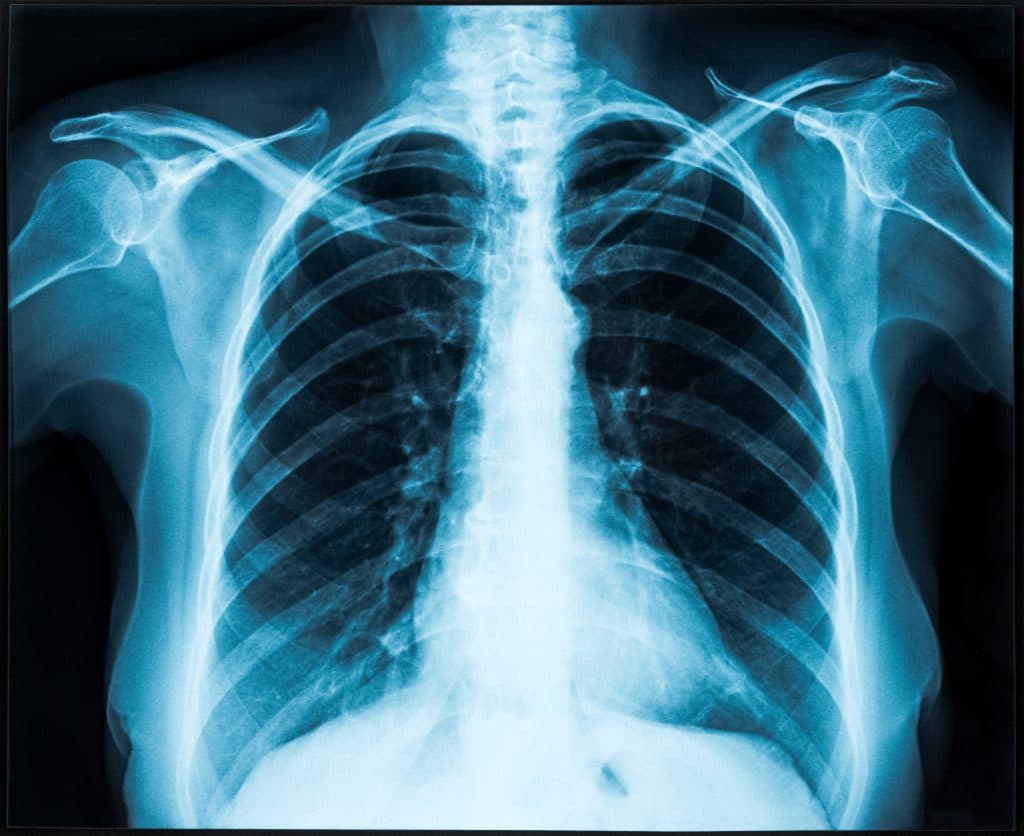 X-ray