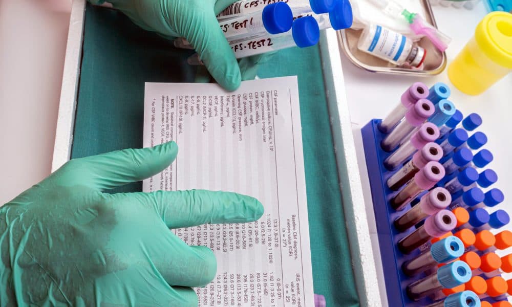 Scientific analyzes results of cerebrospinal fluid in patients with transverse myelitis after being injected with an experimental Oxford covid-19 vaccine, conceptual image Thousands diagnosed with rare genetic diseases in major research study