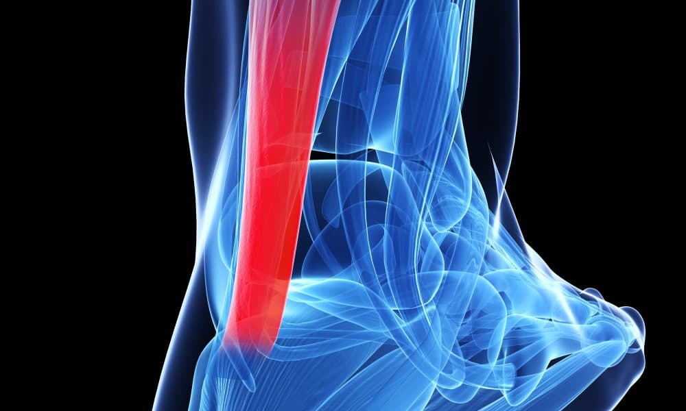 Hyaluronic acid shows strong results in achillles tendon injuries