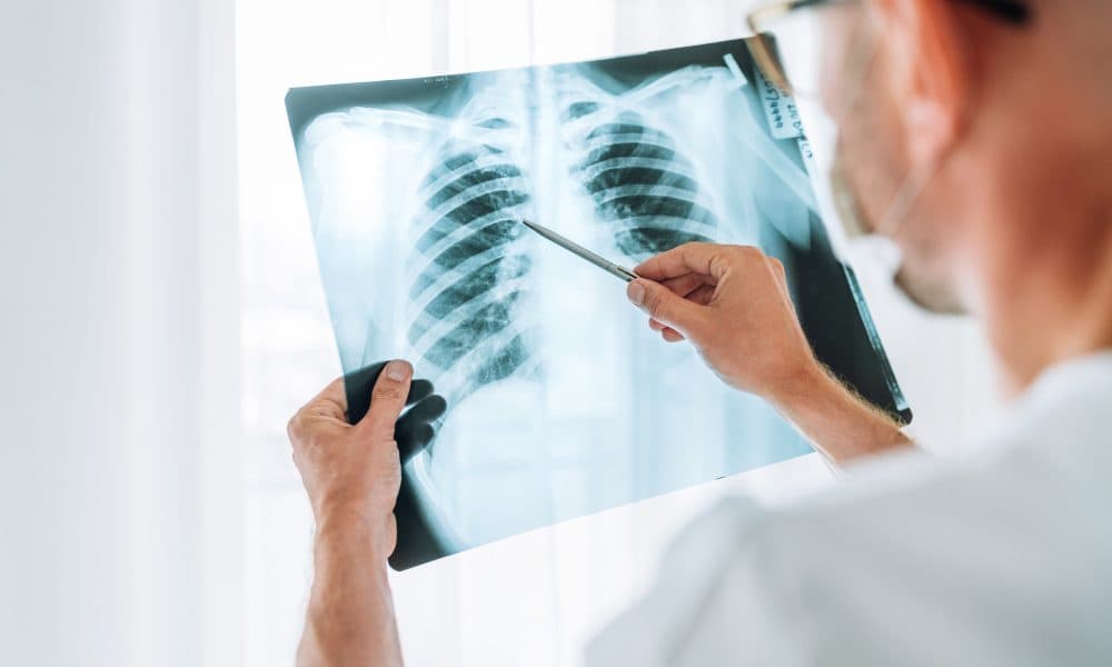 Ruling out abnormal pathology on chest X-rays with AI