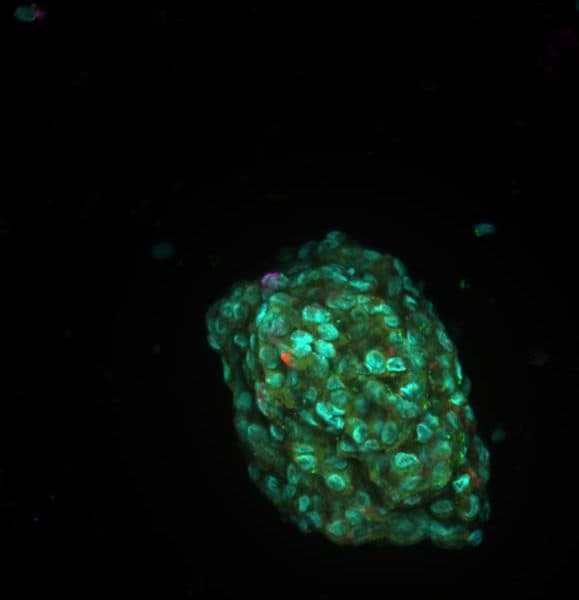 Humans make better cancer treatment decisions than AI, study finds