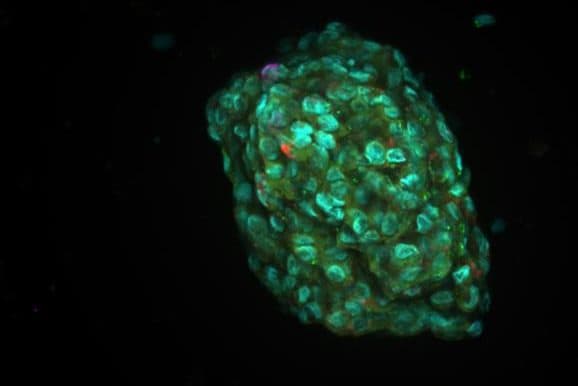 AI cancer treatments