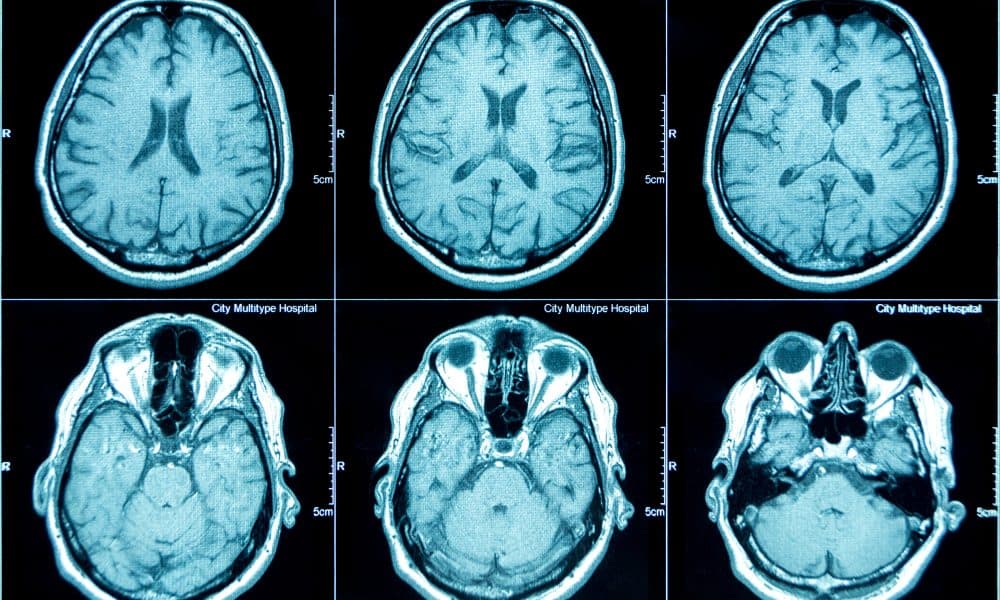 Computer tools can reconstruct 3D brain from biobank photos
