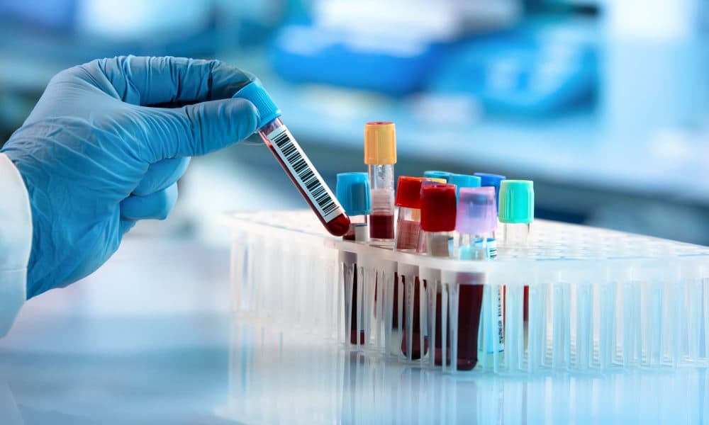 Blood test predicts schizophrenia psychosis and matches treatments