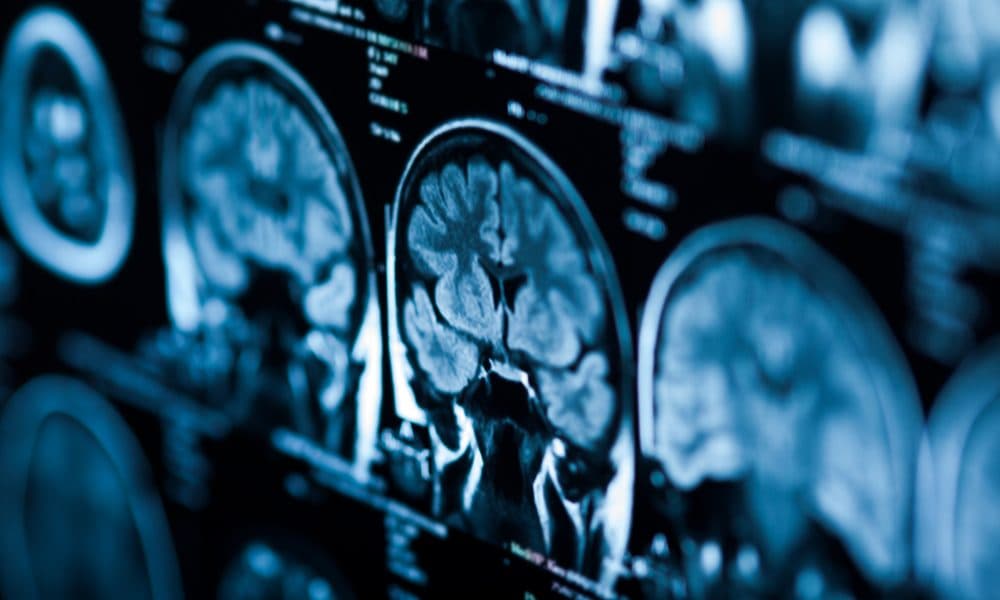 The X-ray of the human brain Drugs for HIV and AIDS trialled as brain tumour treatment