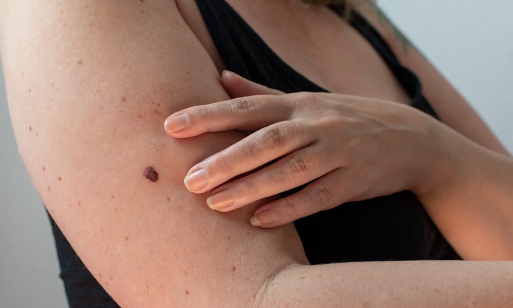 AI-powered device identifies 5% of all UK melanoma cases