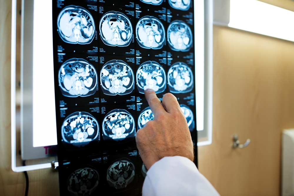 AI tool speeding up stroke diagnosis in England
