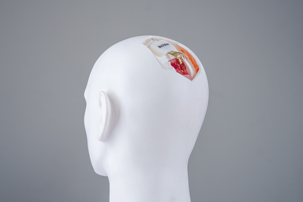 Neurotech start-up ReVision Implant secures €4 million funding