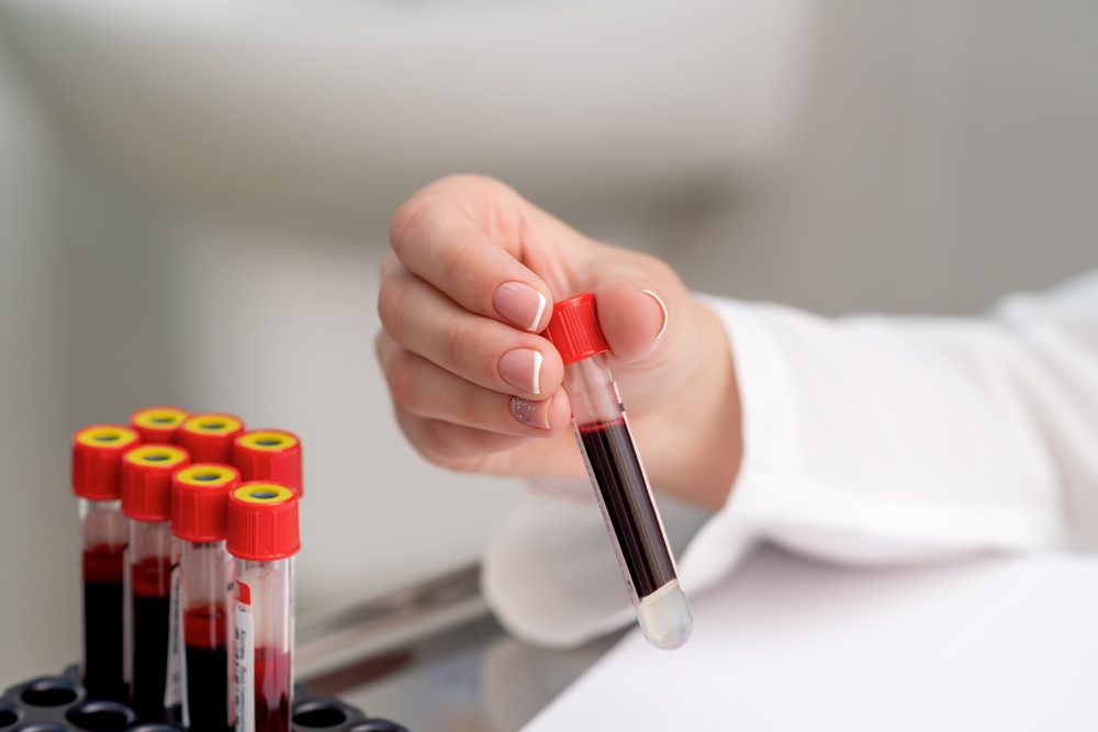 Doctor hand holding test tube with blood sample, close up. New study reveals promising new way to find serious liver disease earlier